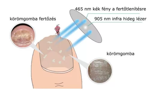 EcoMedi MediLaser Lézeres körömgomba kezelő készülék lábujjakra